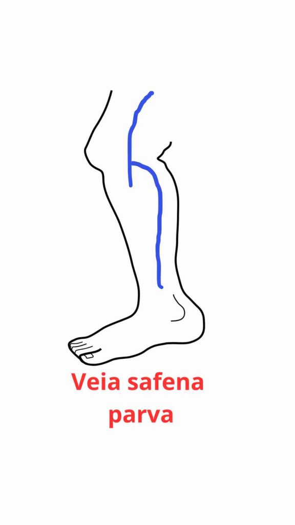 Veia safena parva: Quando tratar?