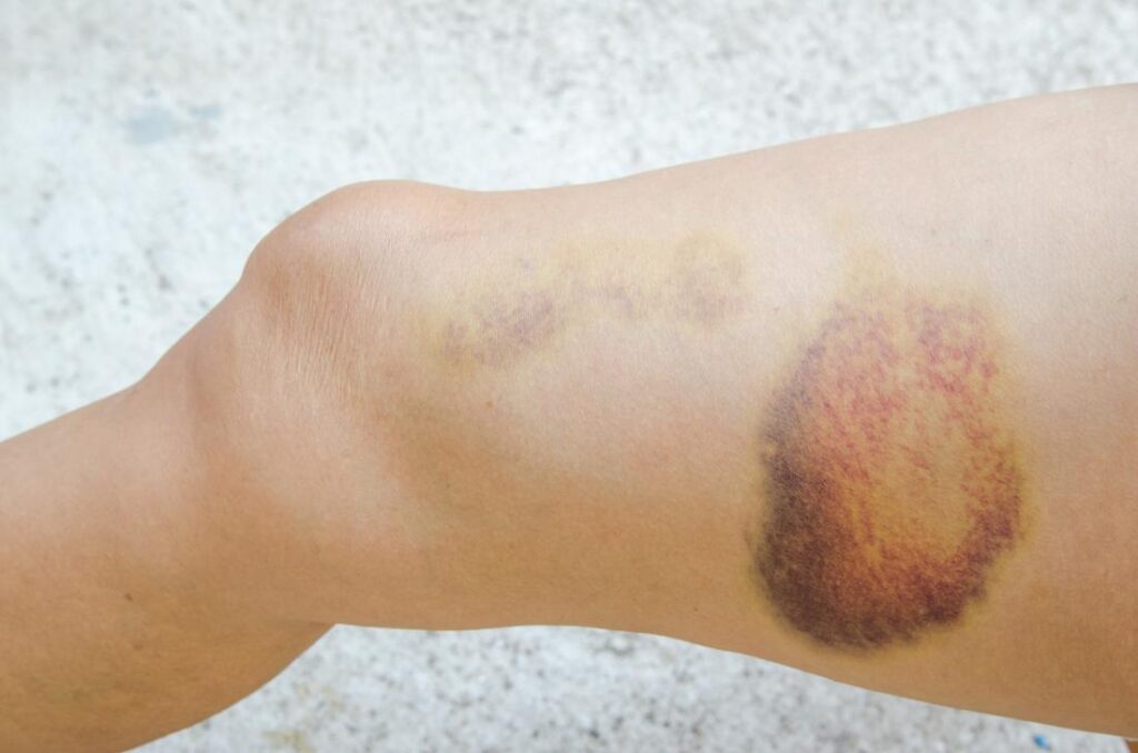 Hematomas e manchas nas pernas