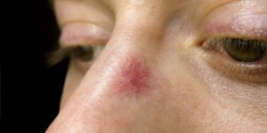 Veias e vasinhos na face qual o tratamento? Veias e vasinhos na face qual o tratamento?