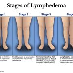 Desvendando os Desafios: Lipedema e Varizes
